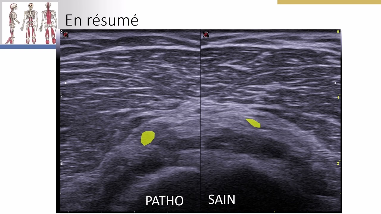 Hydrodissection dans le syndrome du tunnel radial