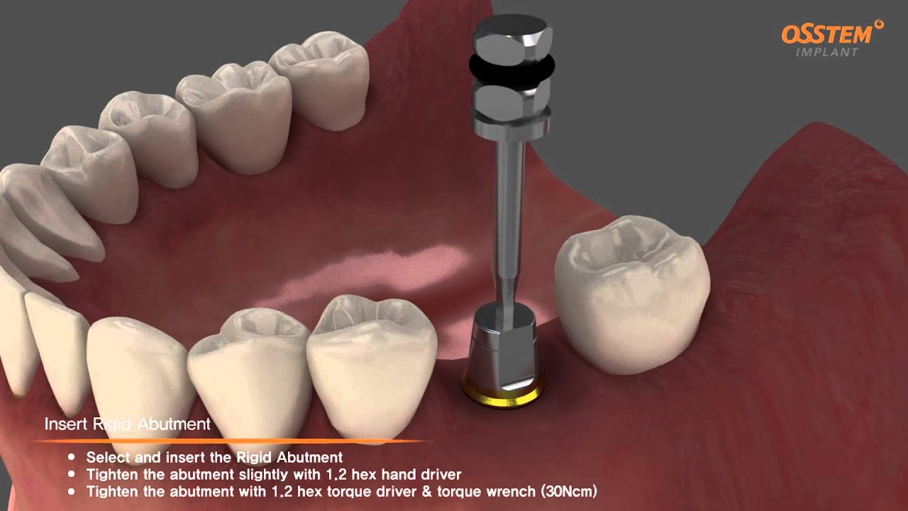TSIII implantátum Rigid felépítménnyel