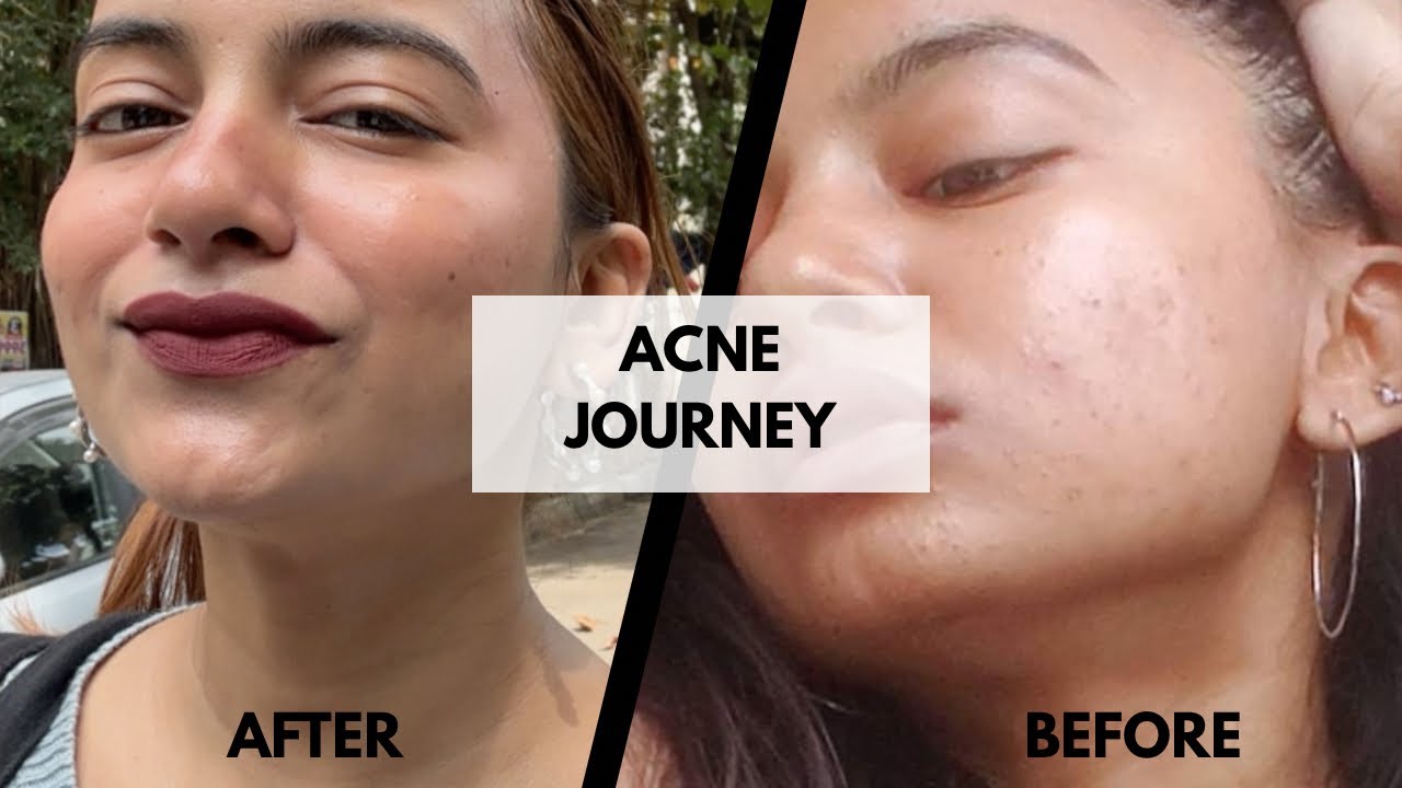 My Acne Journey | How I cleared My Acne | How I achieve this Skin | #retinol #skincare 