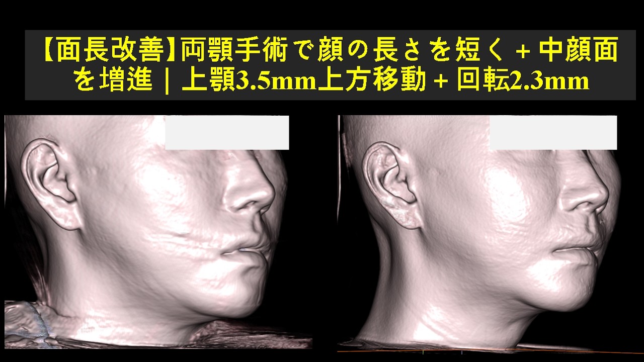 【面長改善】両顎手術で顔の長さを短く＋中顔面を増進｜上顎3.5mm上方移動＋回転2.3mm