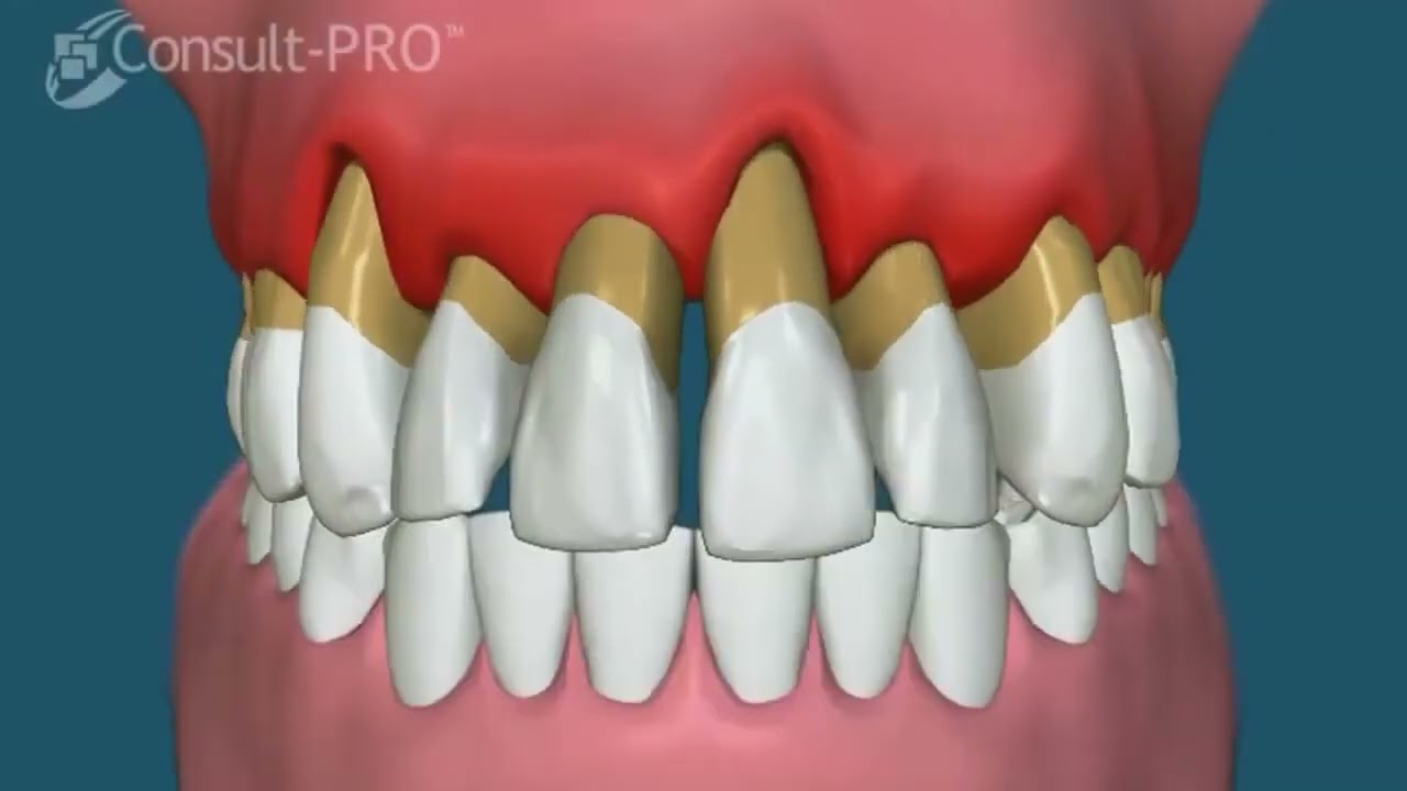 Pérdida de Dientes (San Juan PR Dentist)