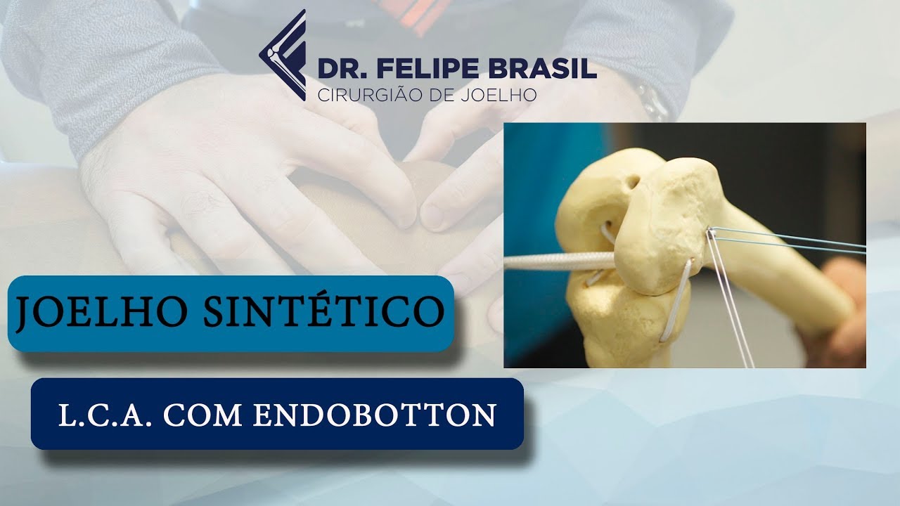 CIRURGIA DO LCA COM ENDOBOTTON - WORKSHOP