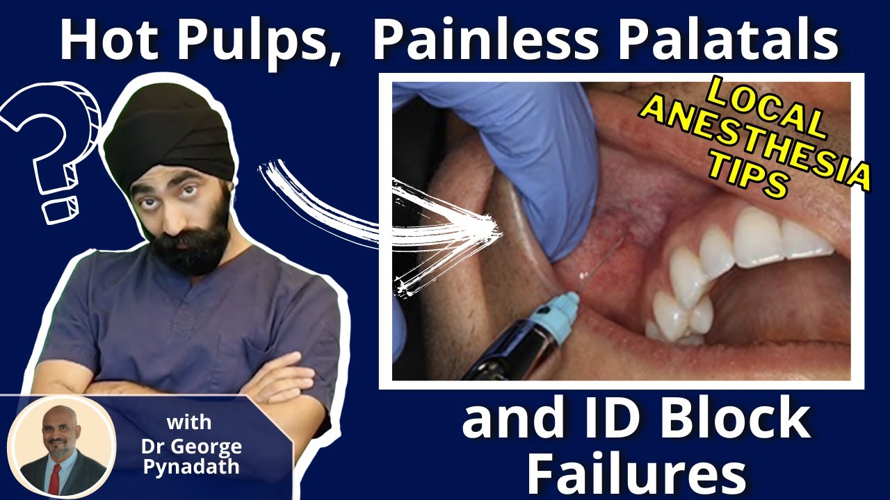 Hot Pulps, Painless Palatals and ID Block Failures - Success with Local Anaesthesia Dentistry PDP084