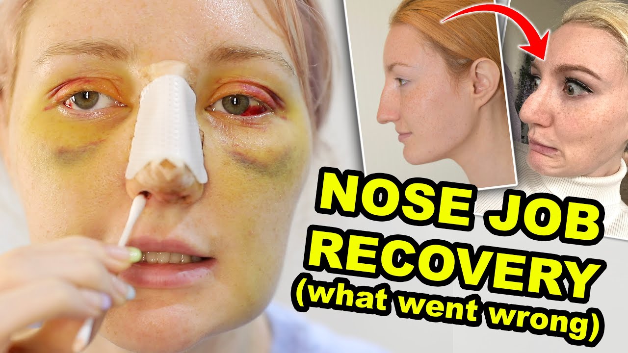 MY NOSE JOB | PART 2 | WHAT WENT WRONG & WHY I REGRET IT