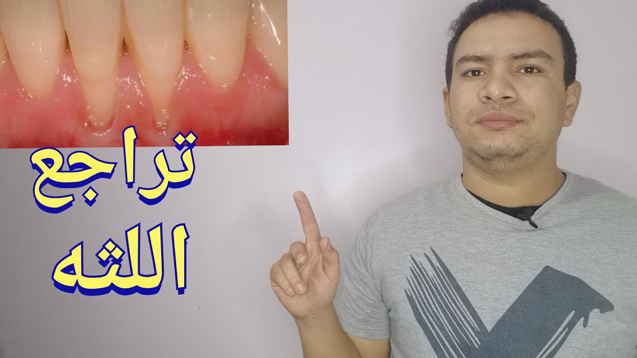 تراجع و انحسار اللثه الاسباب و طرق العلاج