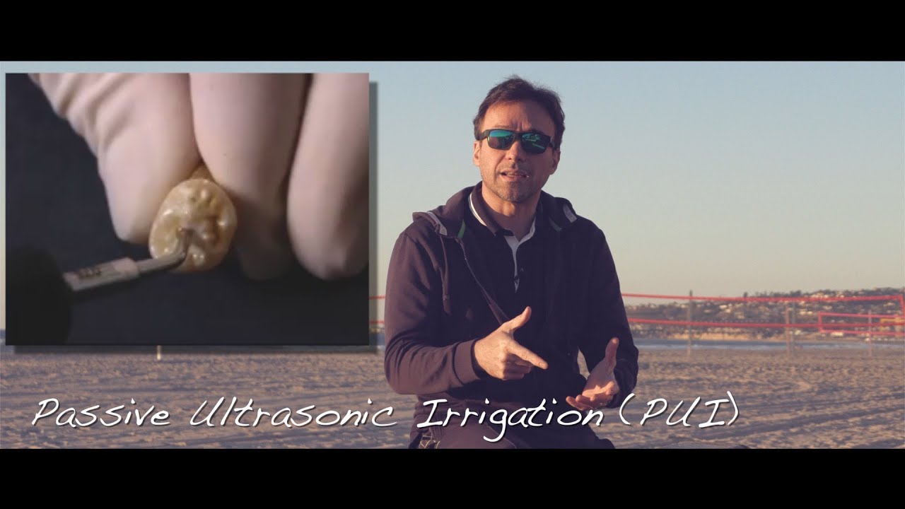 Passive or Active Ultrasonic Activation of Irrigation