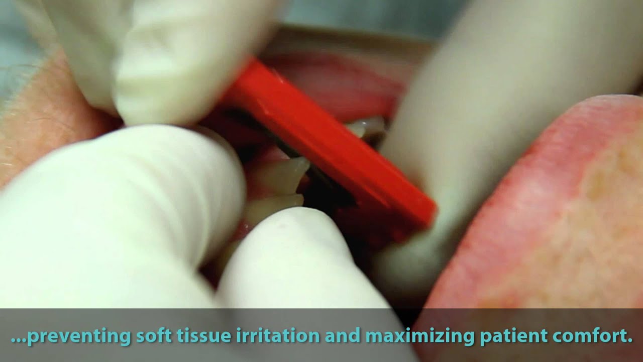 Crowded Teeth - ContacEZ IPR Strip System