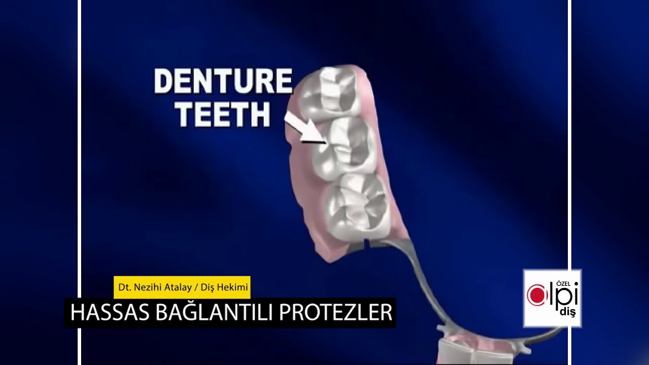 #protez Hassas bağlantılı protezler Nedir? Nasıl Uygulanır?