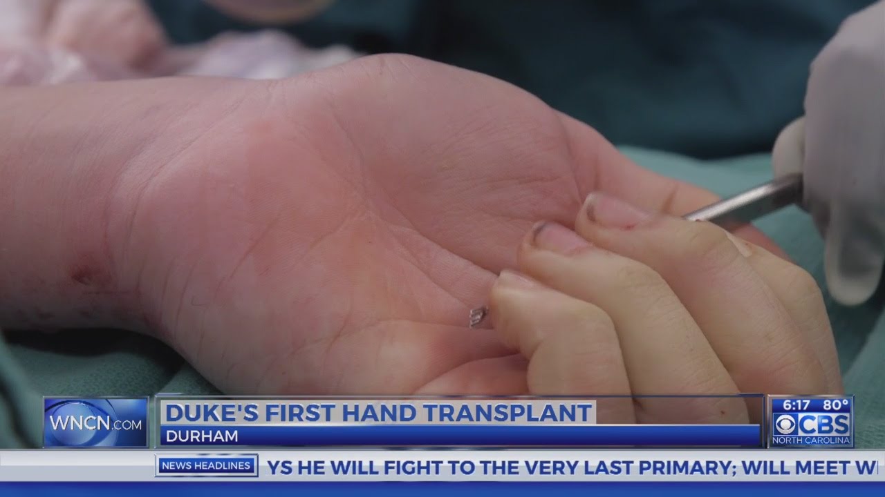 Duke Health performs first hand transplant at the hospital