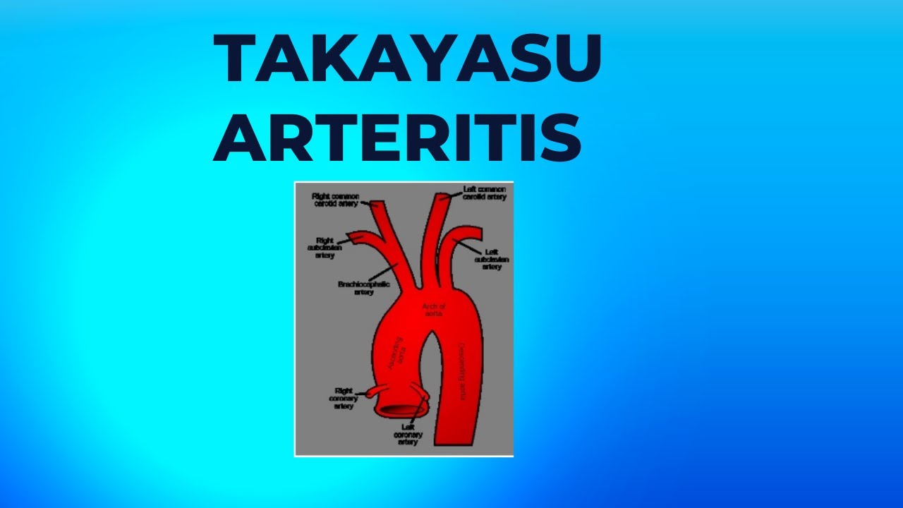Approach to Takayasu Arteritis