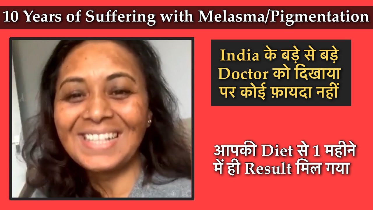 10 years of Melasma going in just 1 month. India के बड़े से बड़े Doctor को दिखाया पर कोई फ़ायदा नहीं