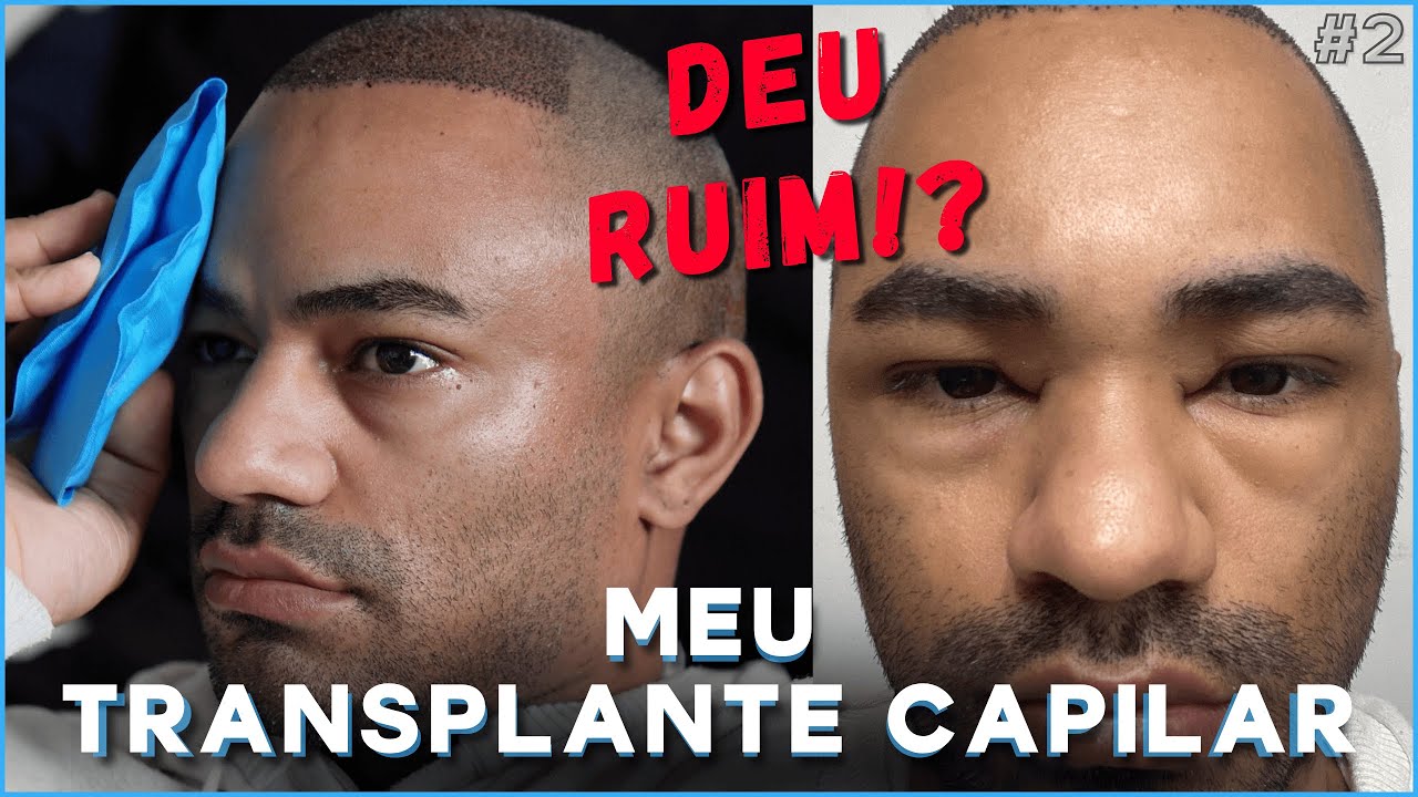 DEU RUIM!? MEU TRANSPLANTE CAPILAR - VLOG #2 