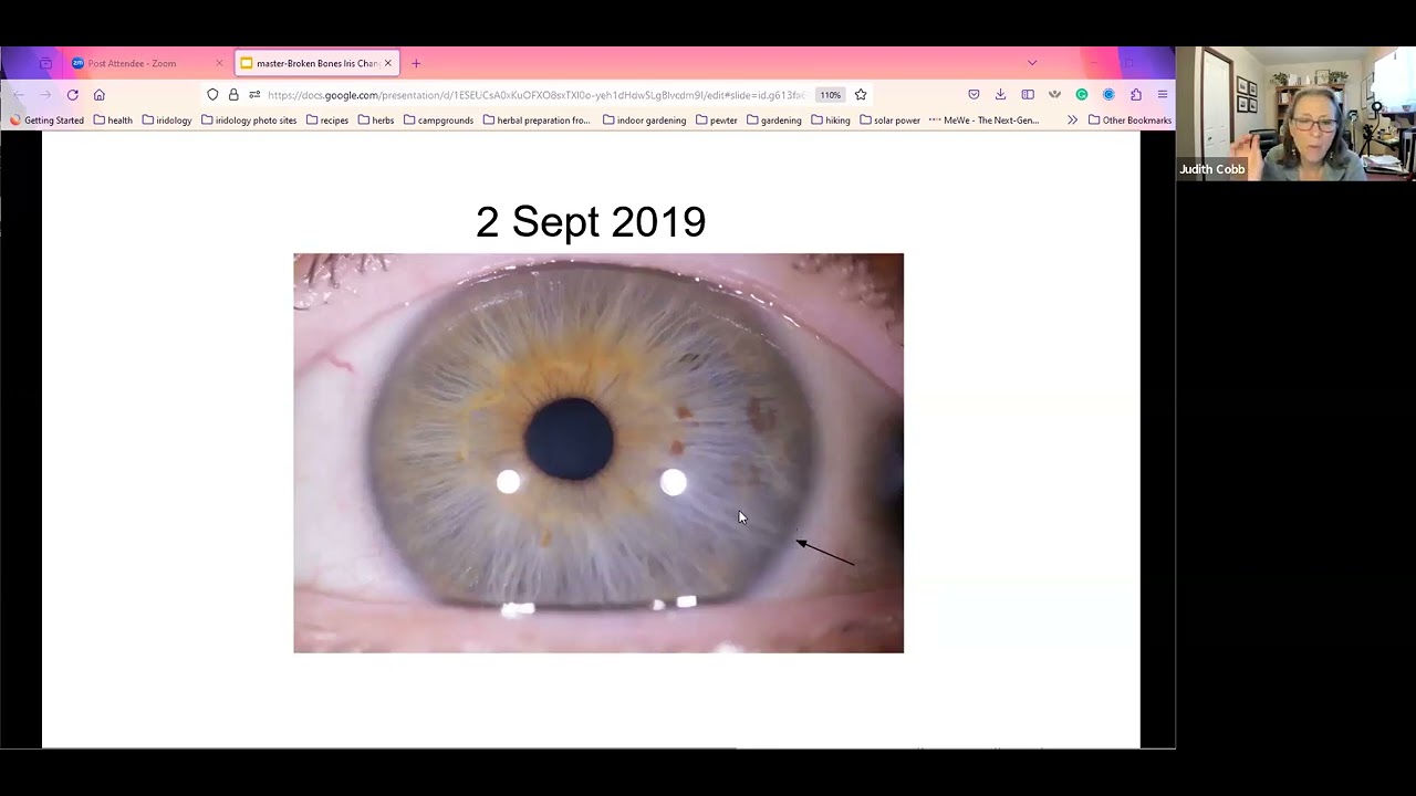 Iridology: How The Irides Record Broken Bones, Surgeries, and Trauma