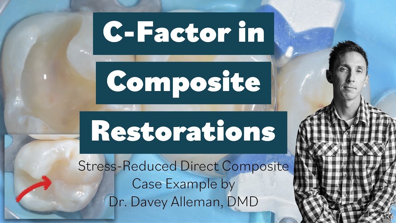 C Factor in Composite Restorations: Stress Reduced Direct Composite Case Example