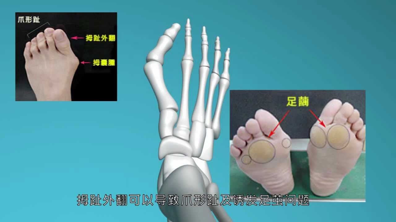 拇趾外翻手术, 拇趾外翻矫正, 拇趾外翻治疗 - 拇趾外翻专科中心 (普通話)