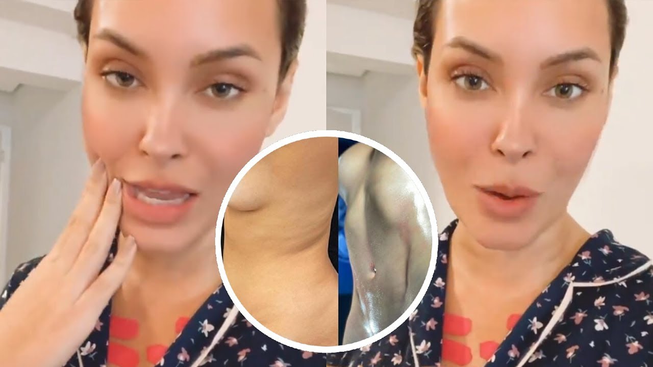 Sarah Andrade faz Lipo Lad, enxertia gl&uacute;tea e coloca silicone. Veja o antes e depois!