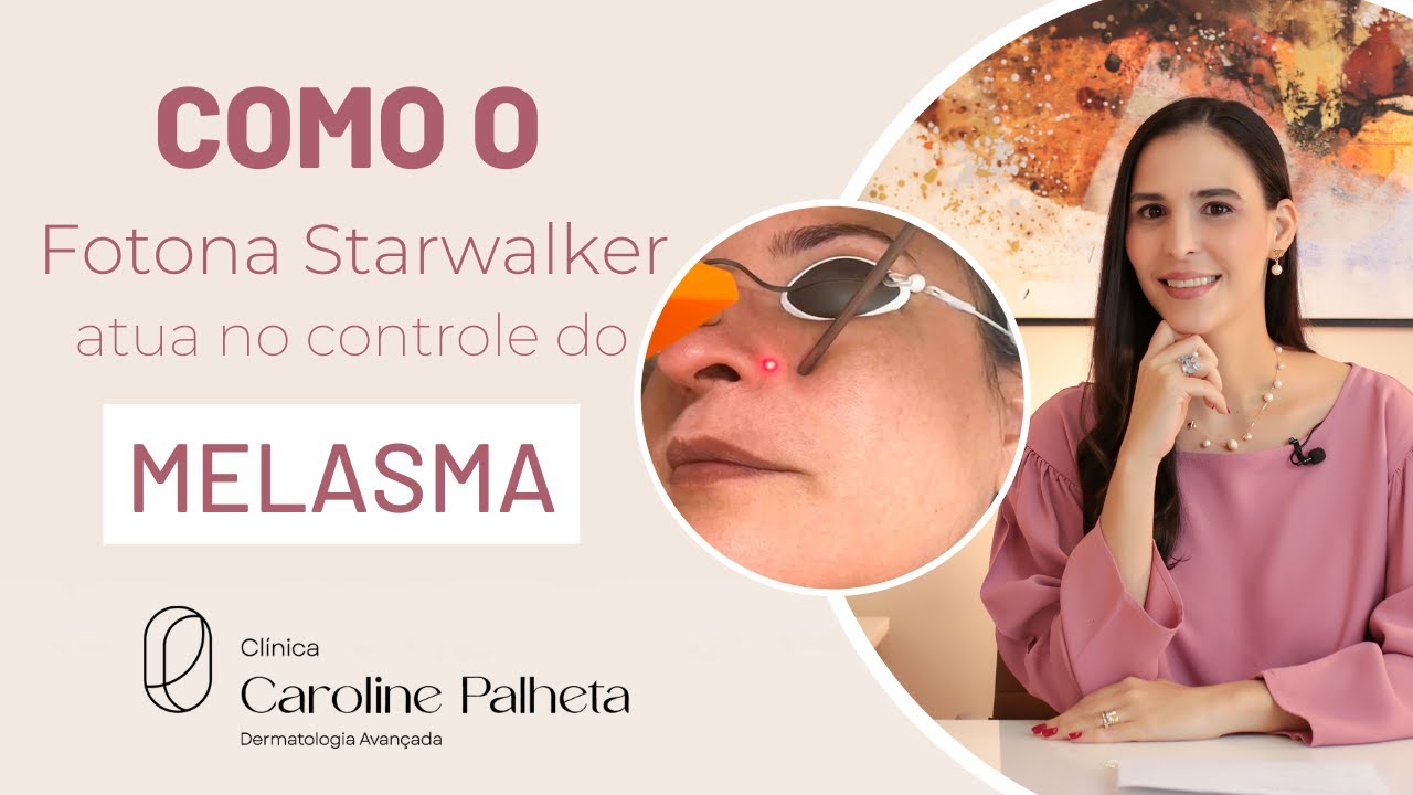 COMO O FOTONA STARWALKER ATUA NO CONTROLE DO MELASMA