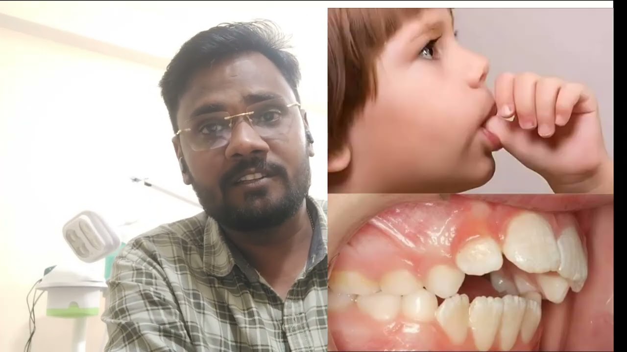 दांतों के बीच मे Gap है.. दांतों में gap है.. Tooth gap @msddental93 