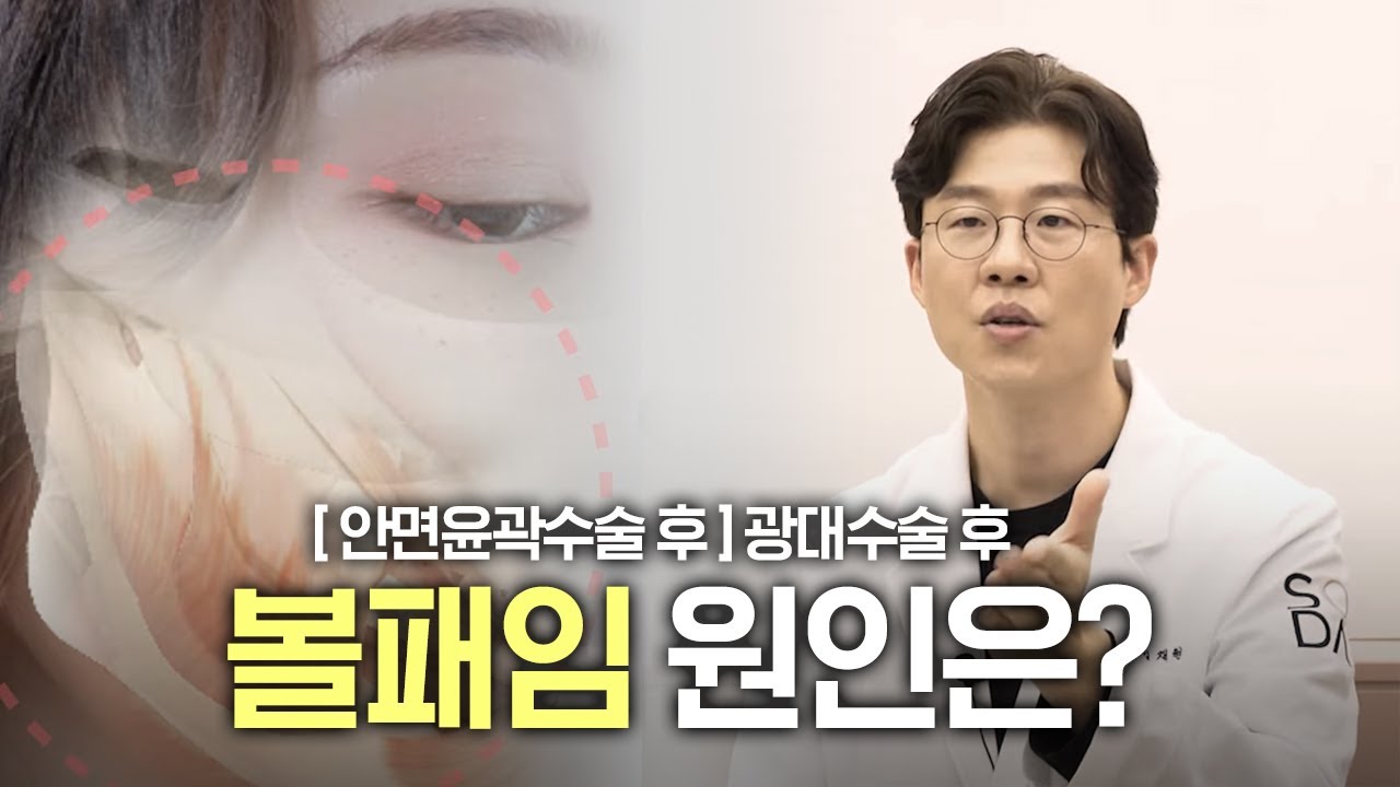 [SODA] 소다성형외과 | 광대수술의 모든것 볼패임이란?