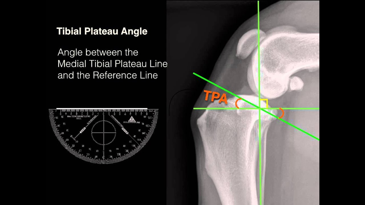 Measuring Tibial Plateau Angle