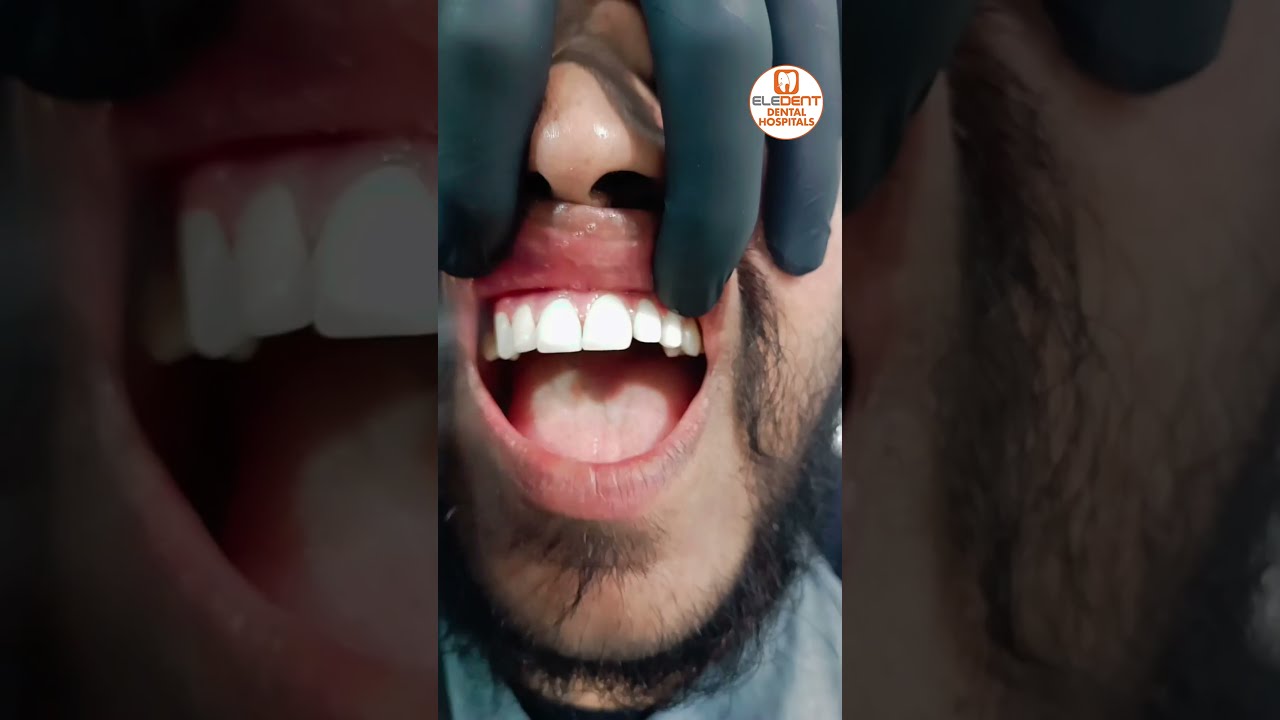 Fixing zirconia Teeth On Live At @EledentDentalHospitals | Best Dental Hospital In India | #shorts