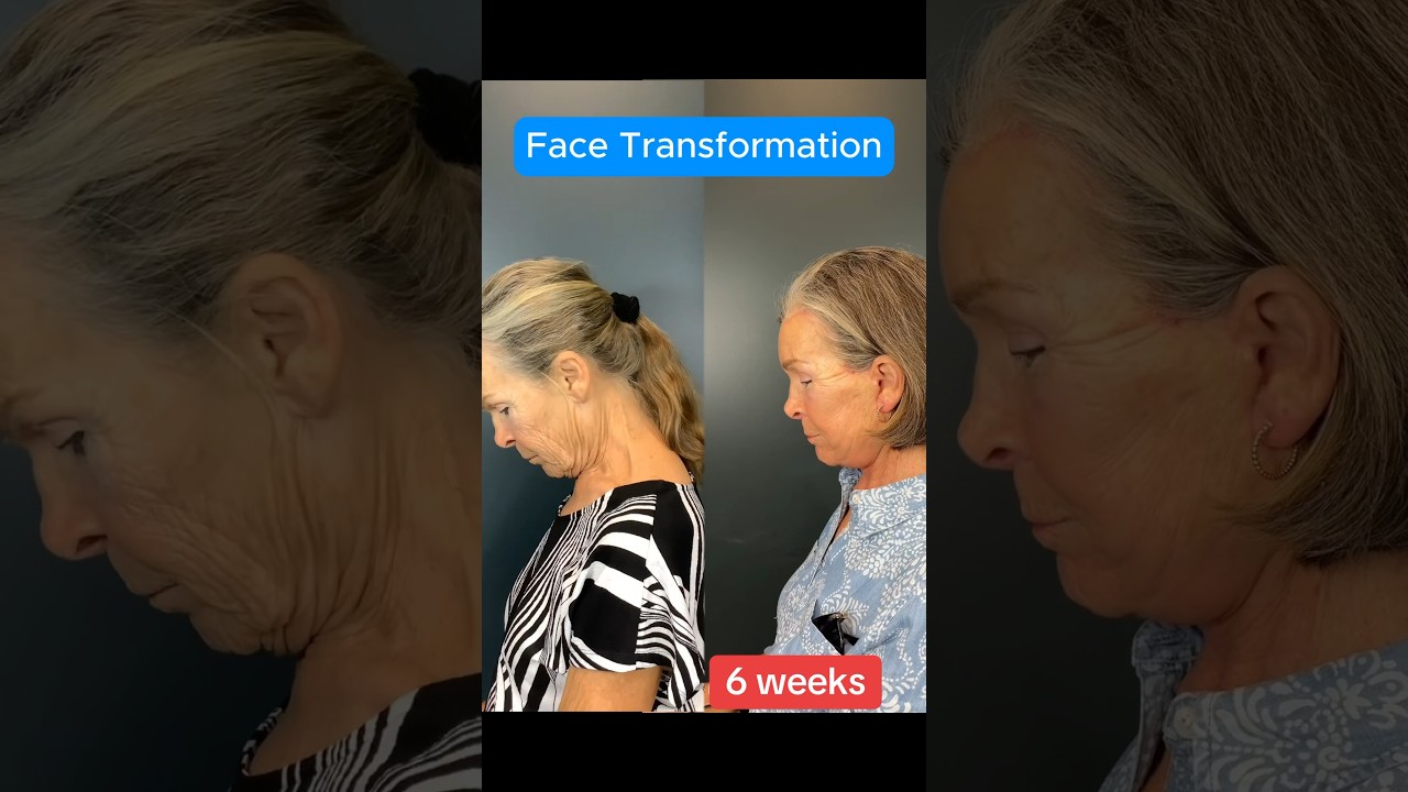 6 Week Update Facelift Transformation (Surgeon Reacts) #facelift