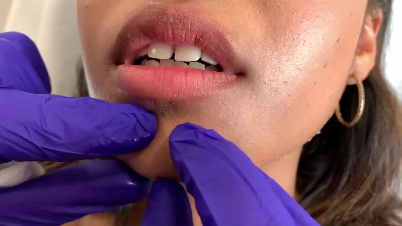 Shaping A Butt Chin: Using Radiesse
