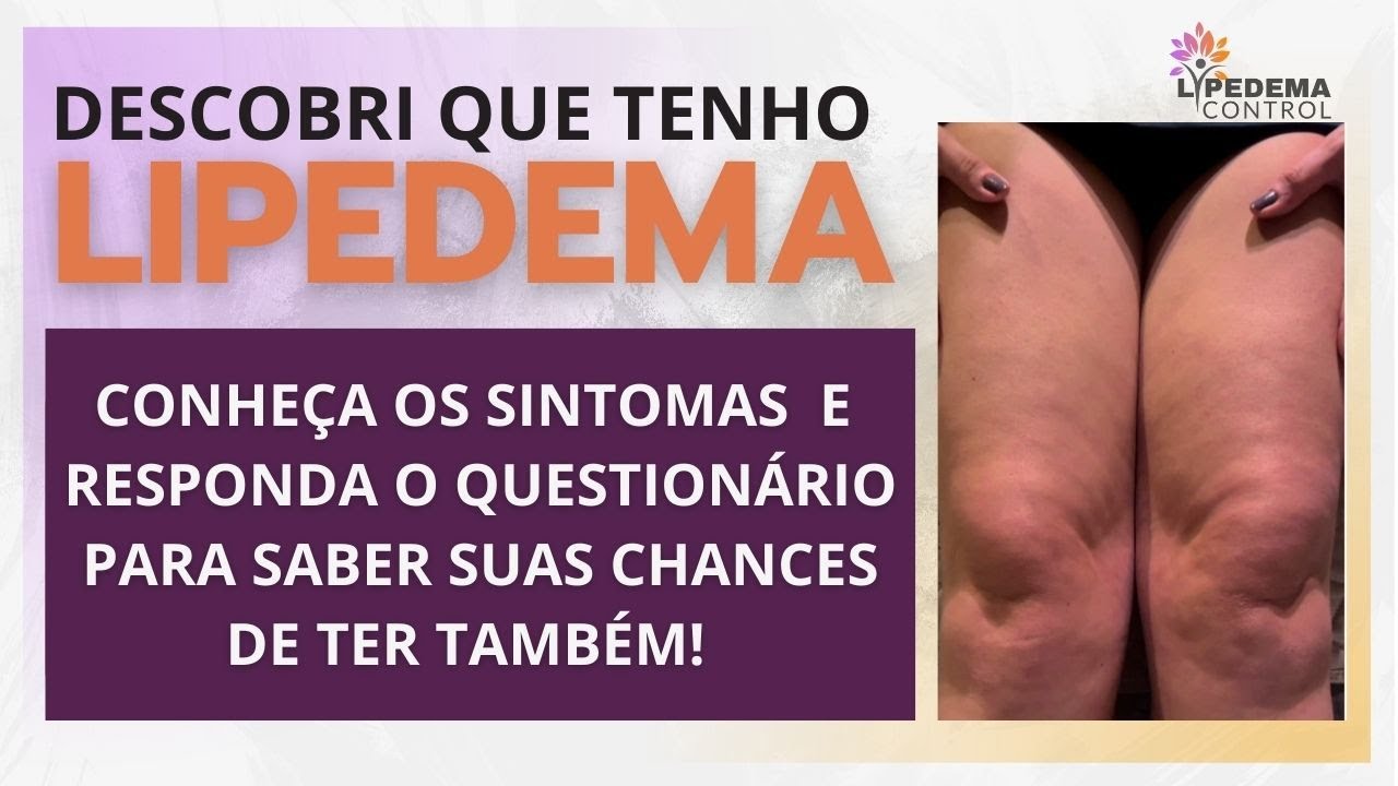 Descobri que tenho Lipedema! Conheça os sintomas e responda o questionário para ver suas chances!