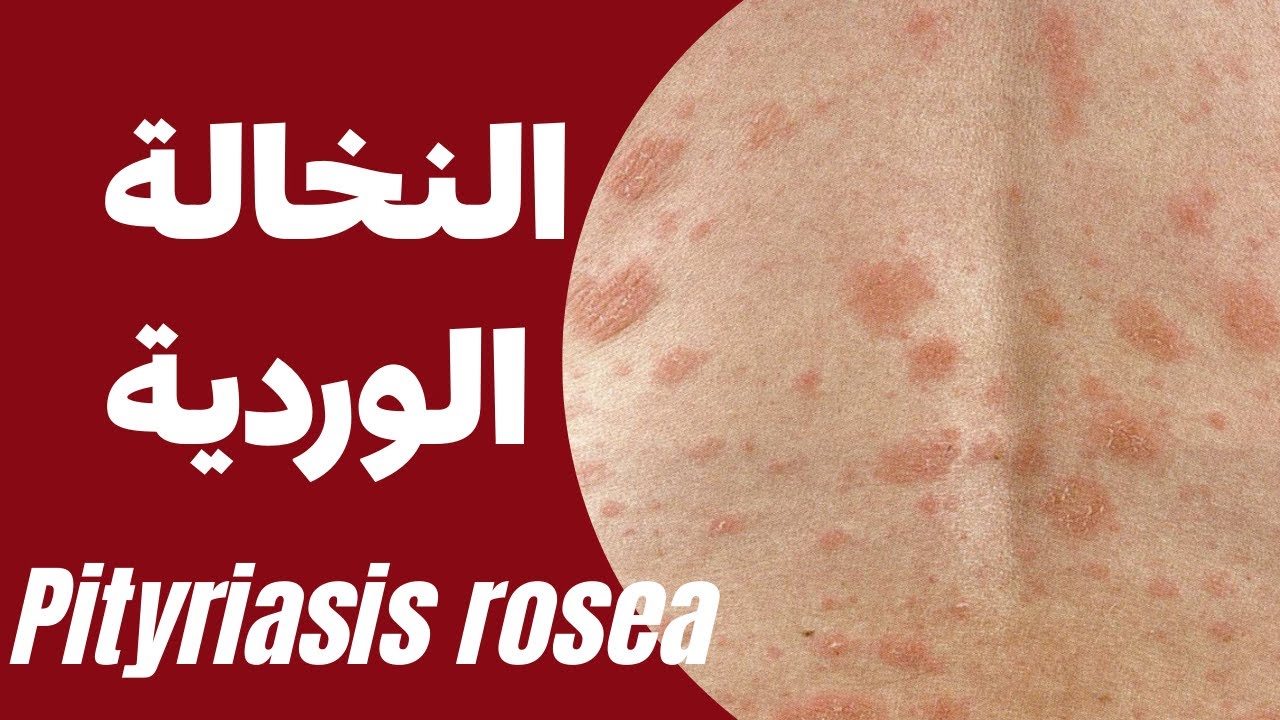 pityriasis rosea| النخالة الوردية | الاسباب | الاعراض | العلاجات | الحالات المستعصية