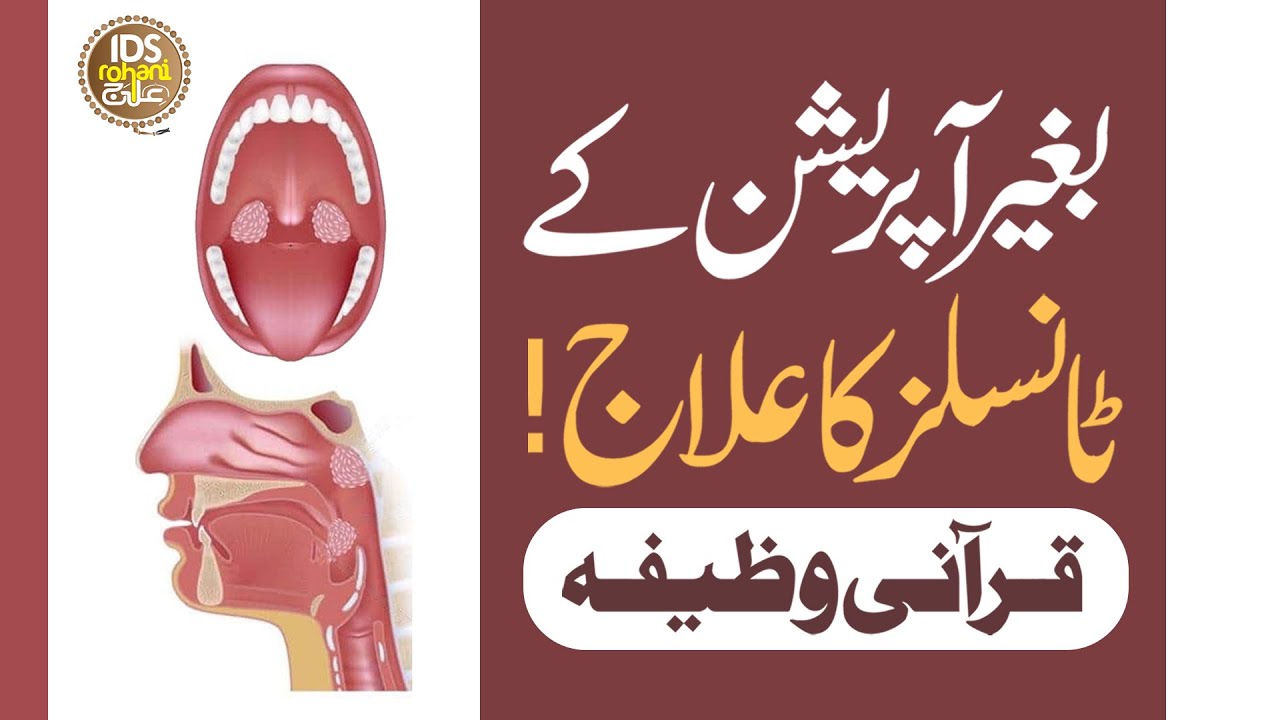 Baghair Operation Ke Tonsils Ka Ilaaj | Gale Ki Bimari Ka Ilaaj | Mufti Ghulam Dastageer