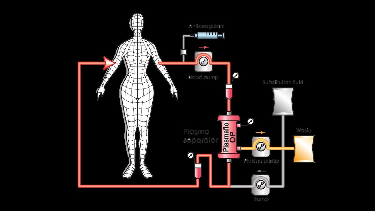 Plasmaféresis: ¿Cuándo, cómo y por qué? - Dr Daniel Osorio - Dr Pedro Alejandro Rojas
