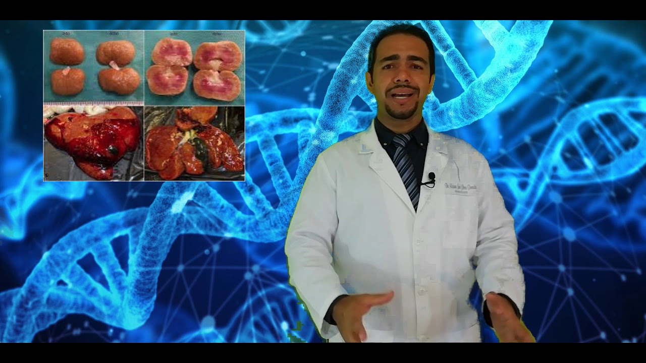 Amiloidosis