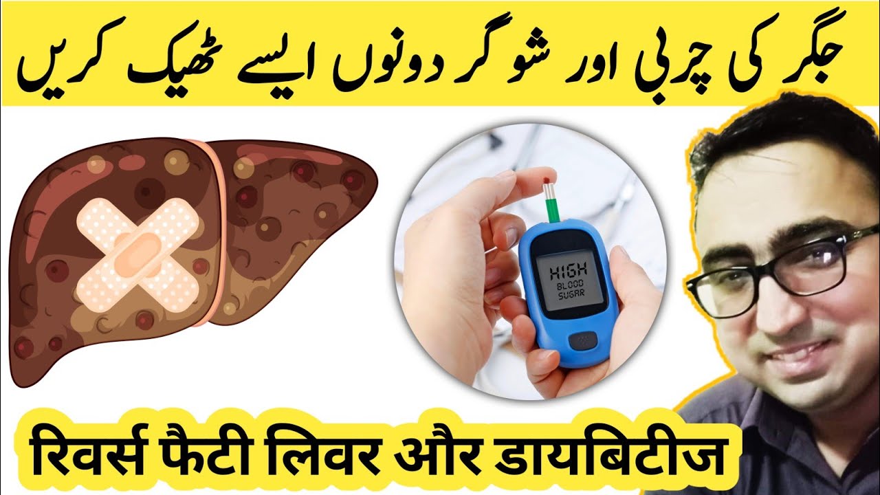 How To Reverse Your Fatty Liver Disease To Lower Insulin Resistance & Treat Diabetes