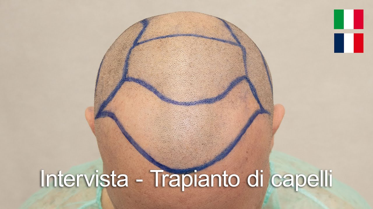 Intervista - Trapianto di capelli in Italia presso la Clinica AraMedica di Lecce