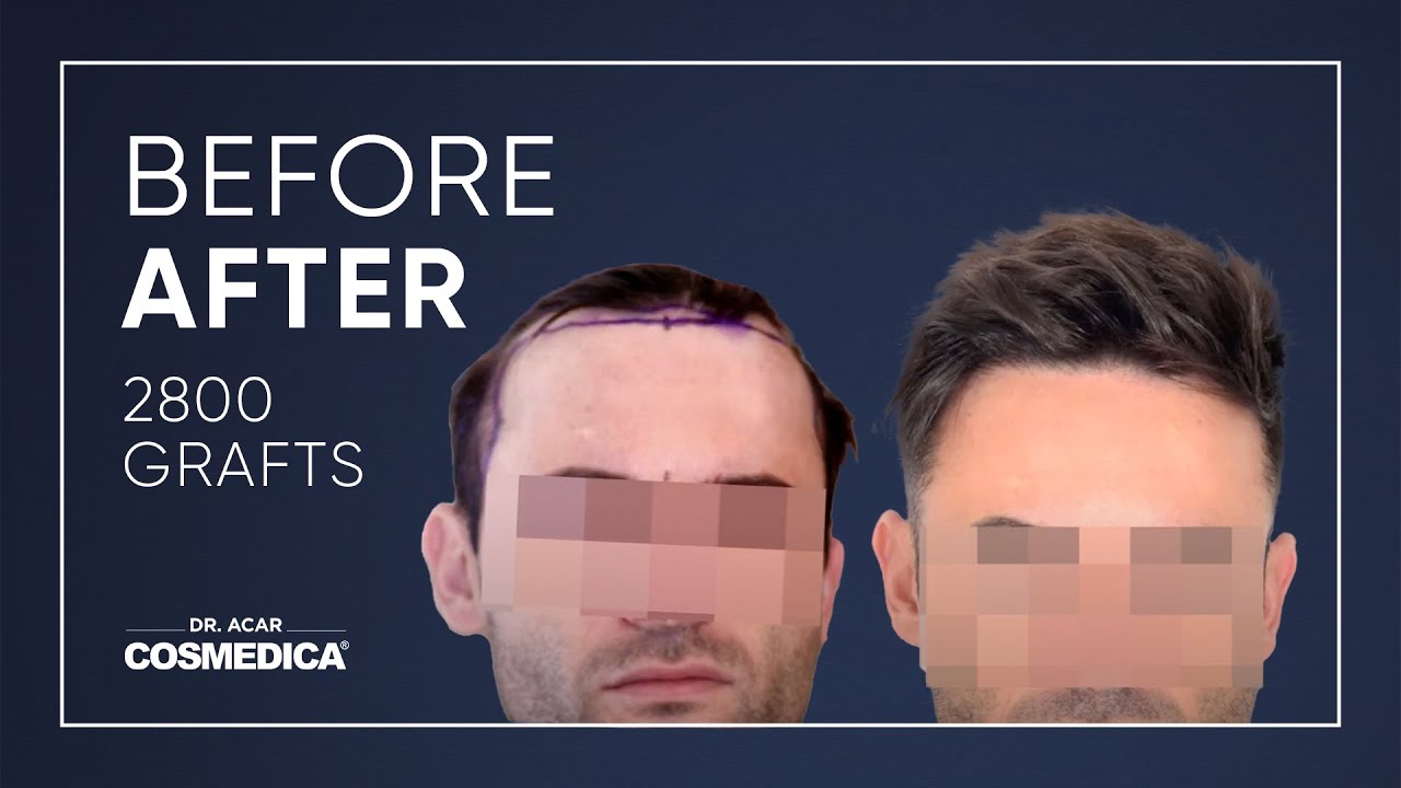 COSMEDICA DR.ACAR ,2800 Grafts  FUE Hair Transplant,Turkey-Istanbul