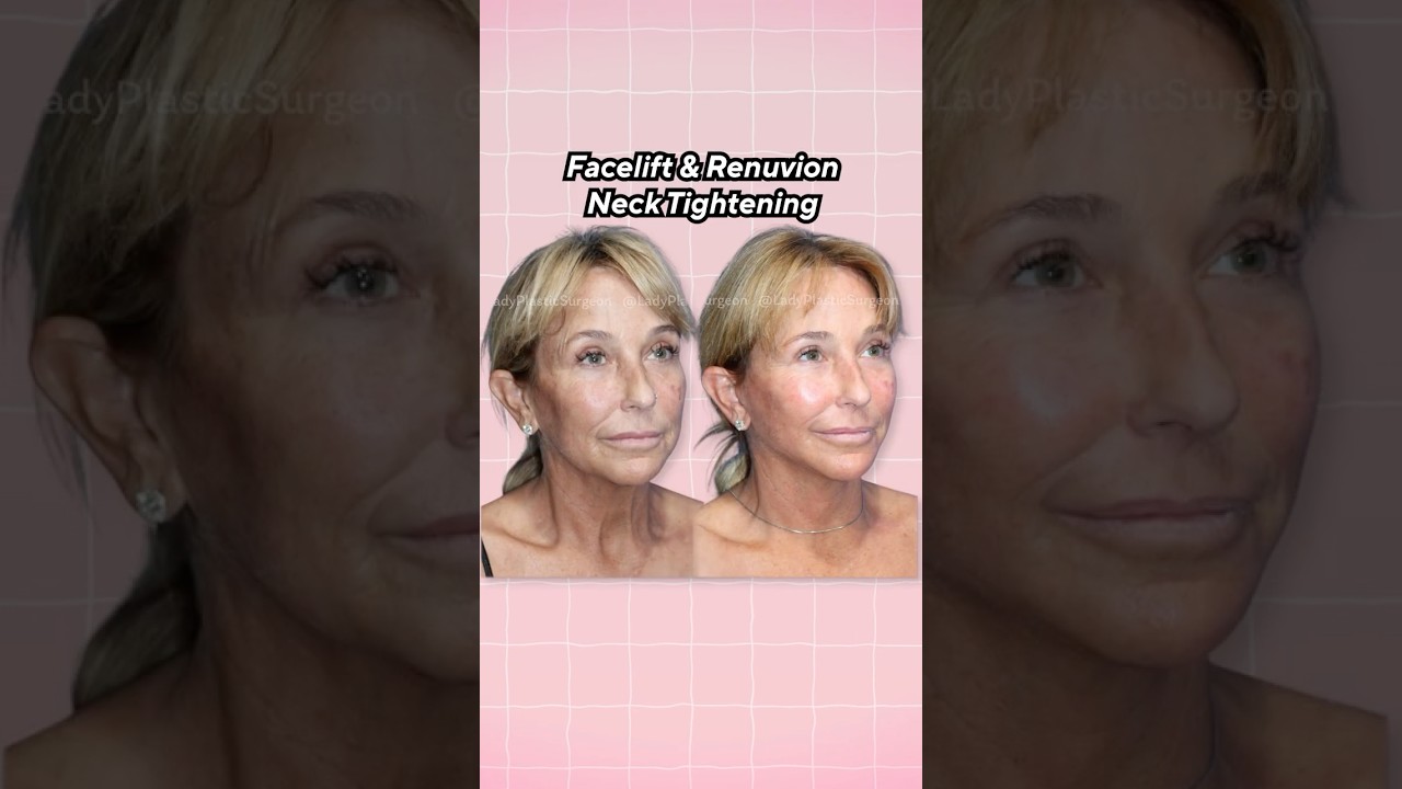 Neck Lift & Renuvion Skin Tightening Before & After Transformation | Dr. Wendy Wong
