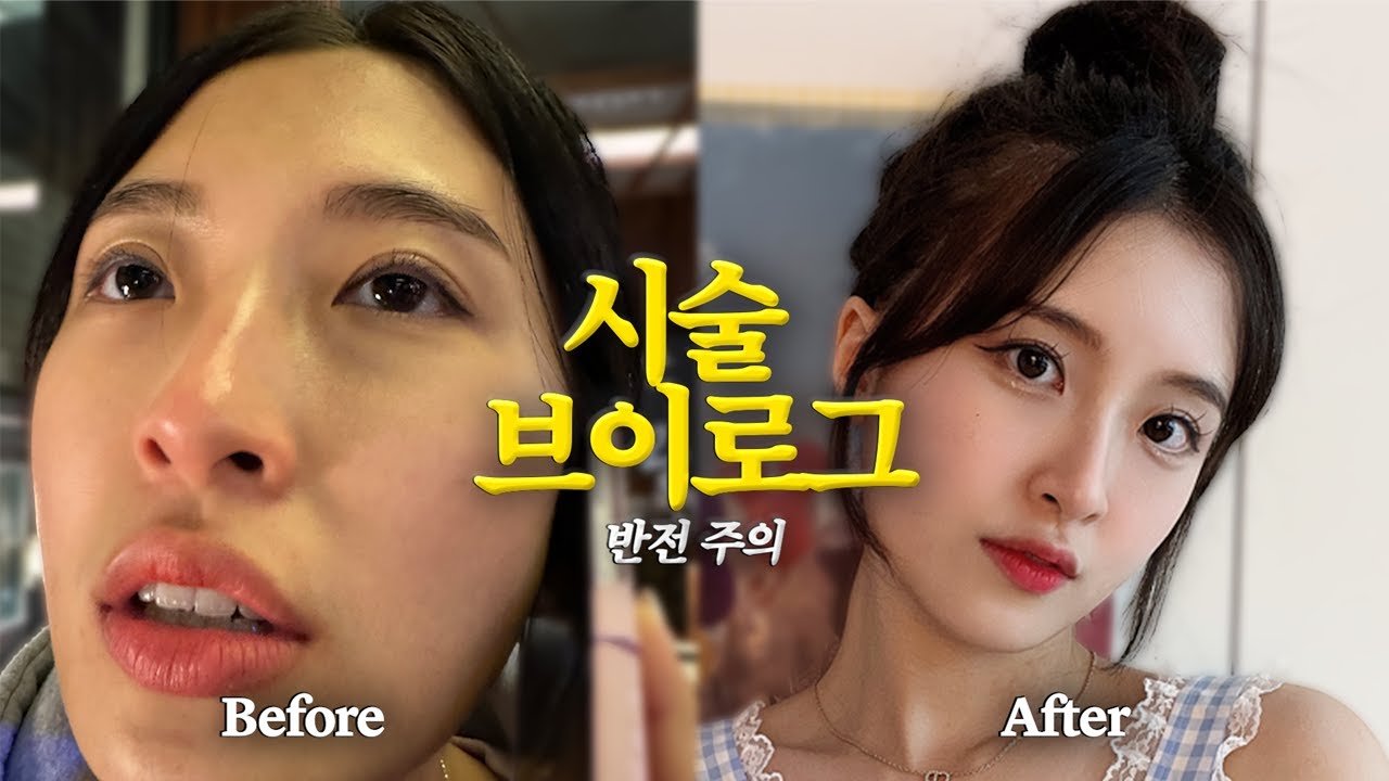 난생처음 이마 필러 시술했더니 레전드 미모라네요 ㄷㄷ;;