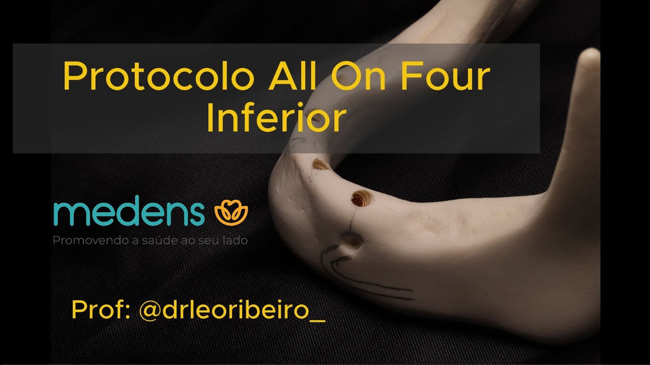 Protocolo All on 4 Inferior - Como Fazer