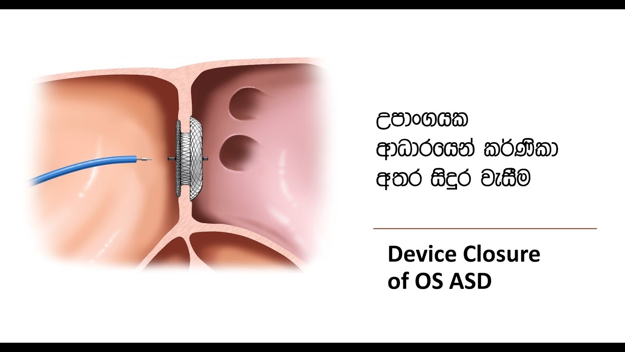 04. හදවතේ කර්ණිකා අතර ඇති සිදුර වහන්නේ කොහොමද?  (ASD  2 වන කොටස)