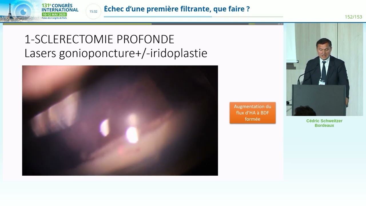 ECHEC D'UNE PREMIERE FILTRANTE QUE FAIRE? DR C SCHWEITZER