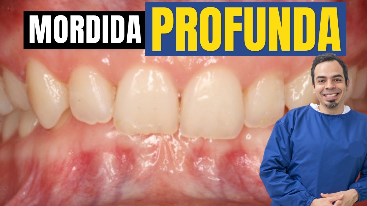 MORDIDA PROFUNDA / NO SE VEN MIS DIENTES ABAJO / TRATAMIENTO DE LA SOBREMORDIDA VERTICAL