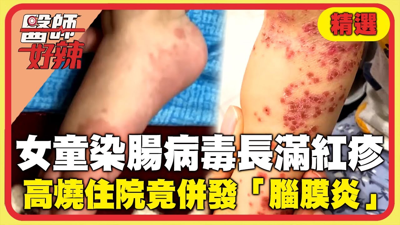 3歲女童染「腸病毒」全身長滿傳染性紅疹！高燒住院意識不清竟是併發「腦膜炎」？【#醫師好辣】精選