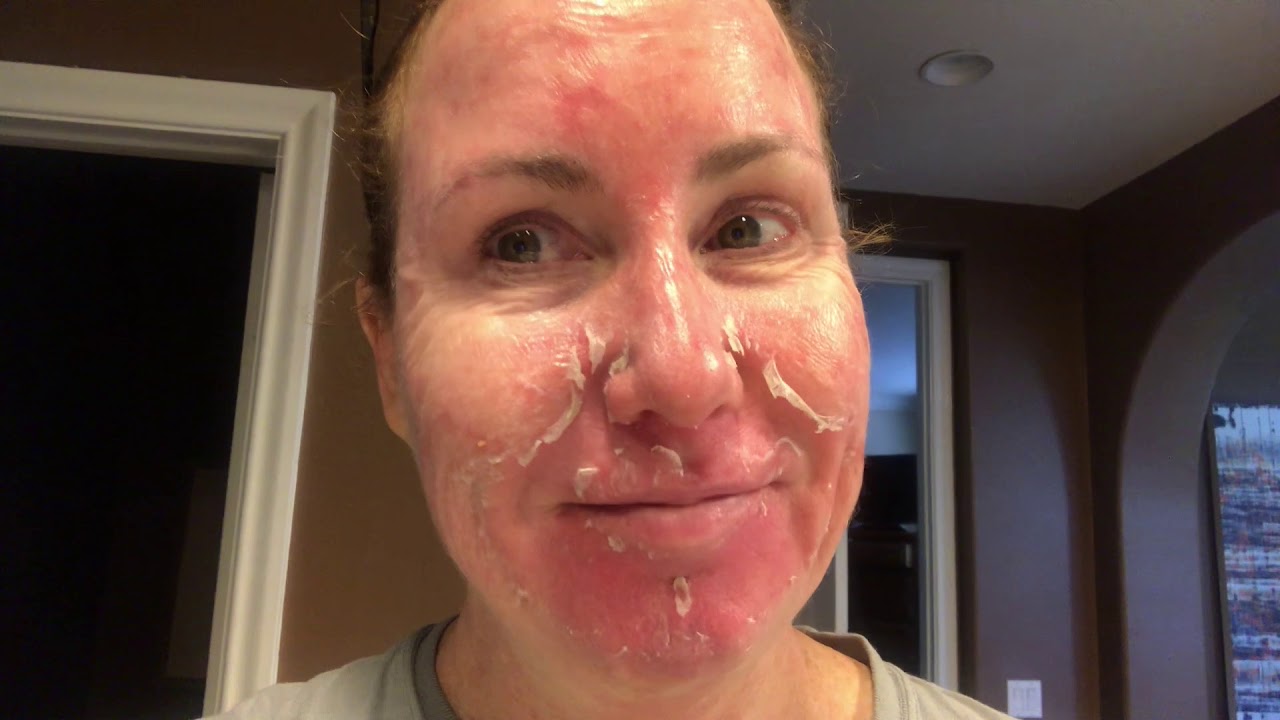 Blue Light Treatment: Kerry's Experience