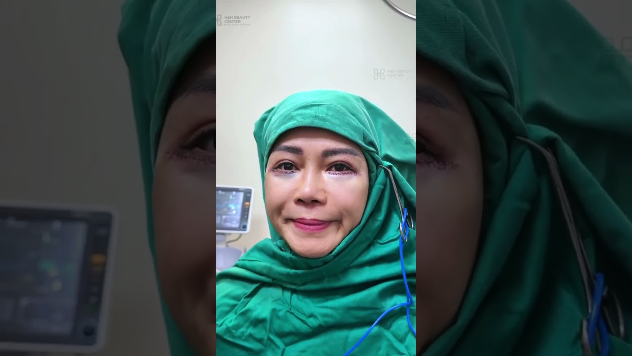 KỸ THUẬT MIDFACE - TRẺ HÓA TẦNG MẶT GIỮA HIỆU QUẢ 3 TRONG 1 CỰC KHÁC BIỆT