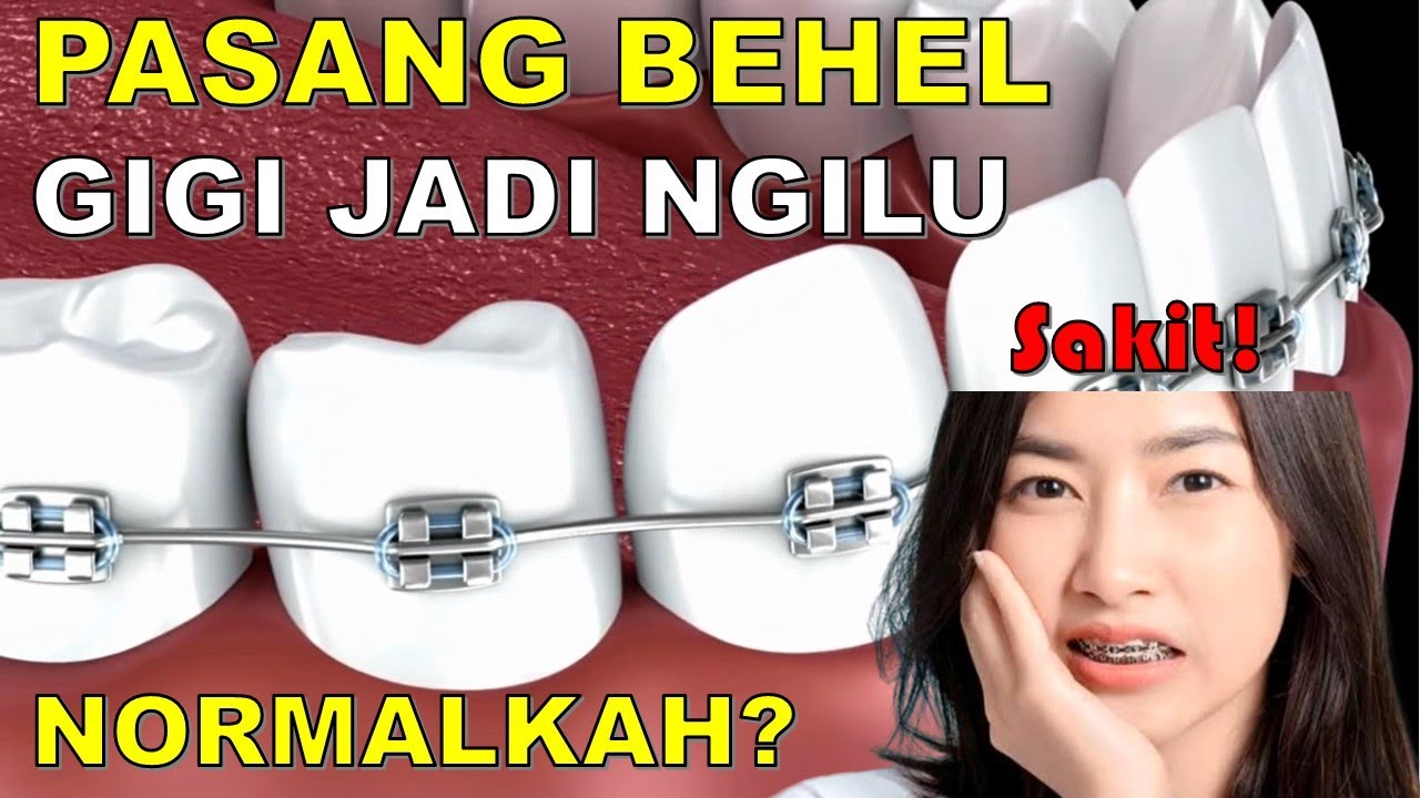 Kenapa gigi ngilu saat pakai behel dan bagaimana cara mengatasinya❓