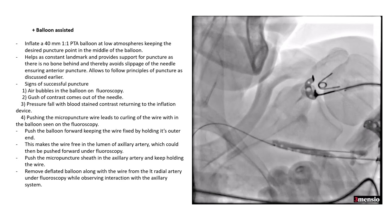 Percutaneous transaxillary TAVR done at NH Kolkata