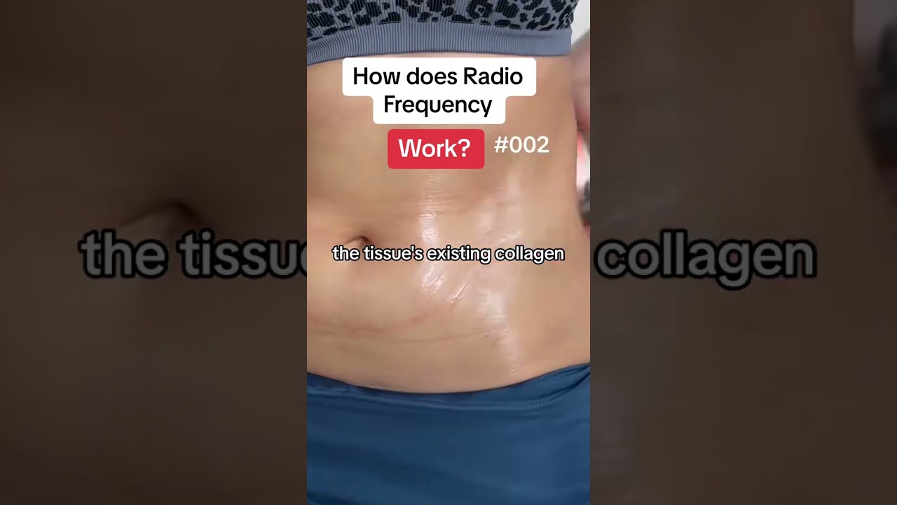 How does radiofrequency skin tightening work?