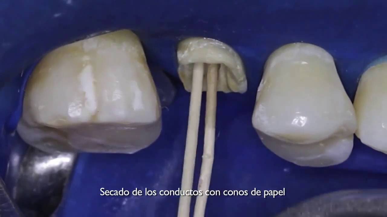 Tópicos Clínicos 04 - Pinos de Fibra e Núcleo tipo Core. Protocolo de Preparo e Cimentação