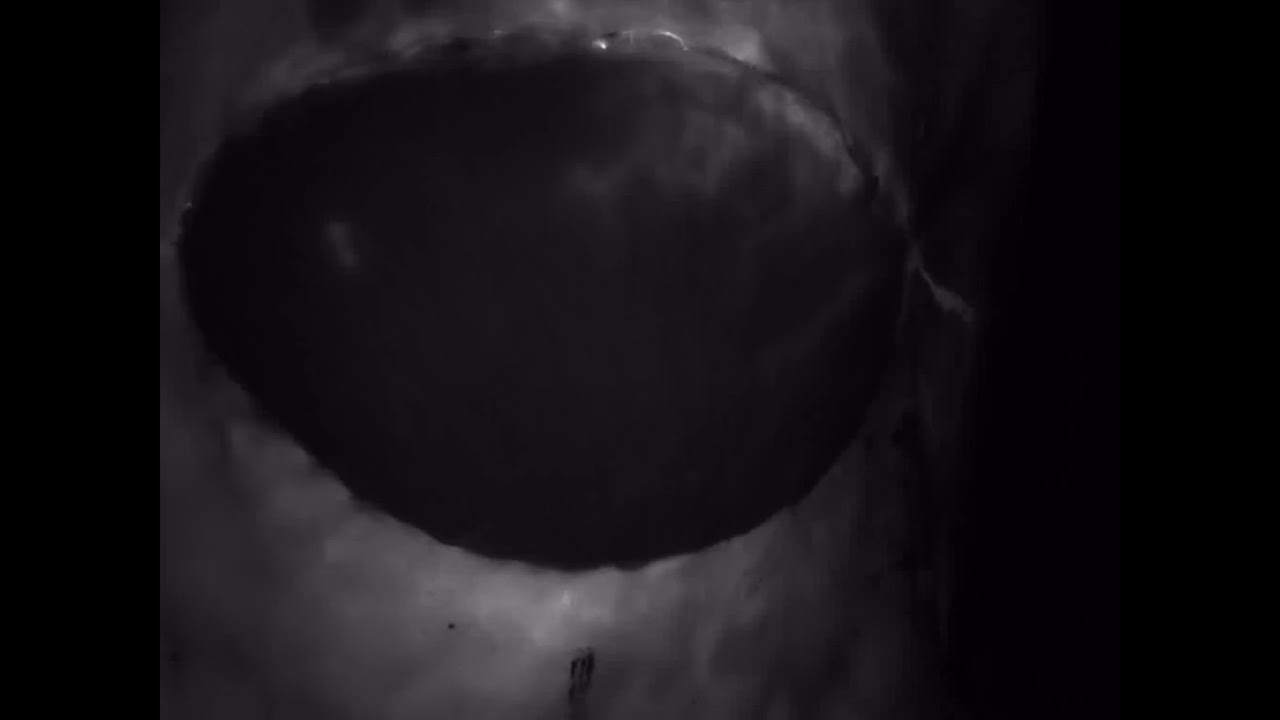 Asvide: Indocyanine green angiography (ICG-A) showing insufficient intra-flap perfusion of a deep&hellip;