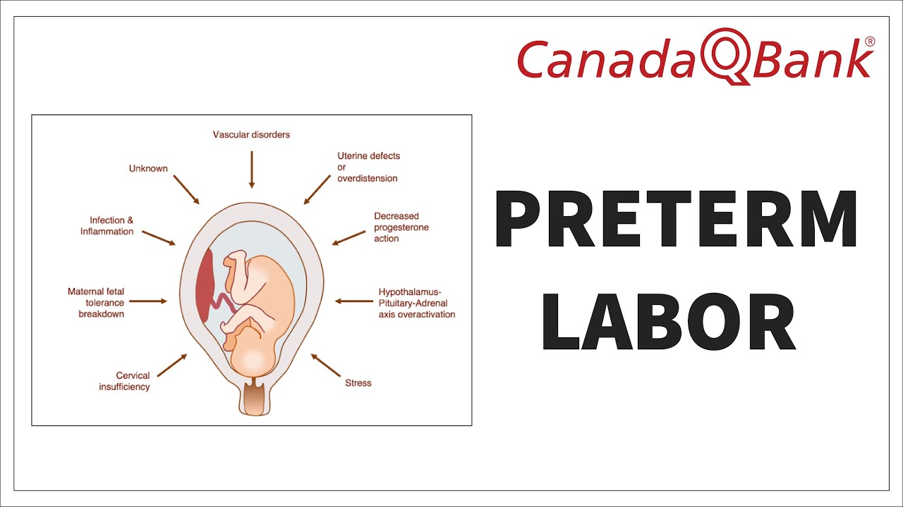 Preterm Labor: Signs, Symptoms, Diagnosis & Treatment | CanadaQBank